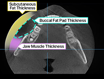 3D CT FIT 얼굴지방흡입