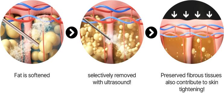 3D CT FIT 얼굴지방흡입